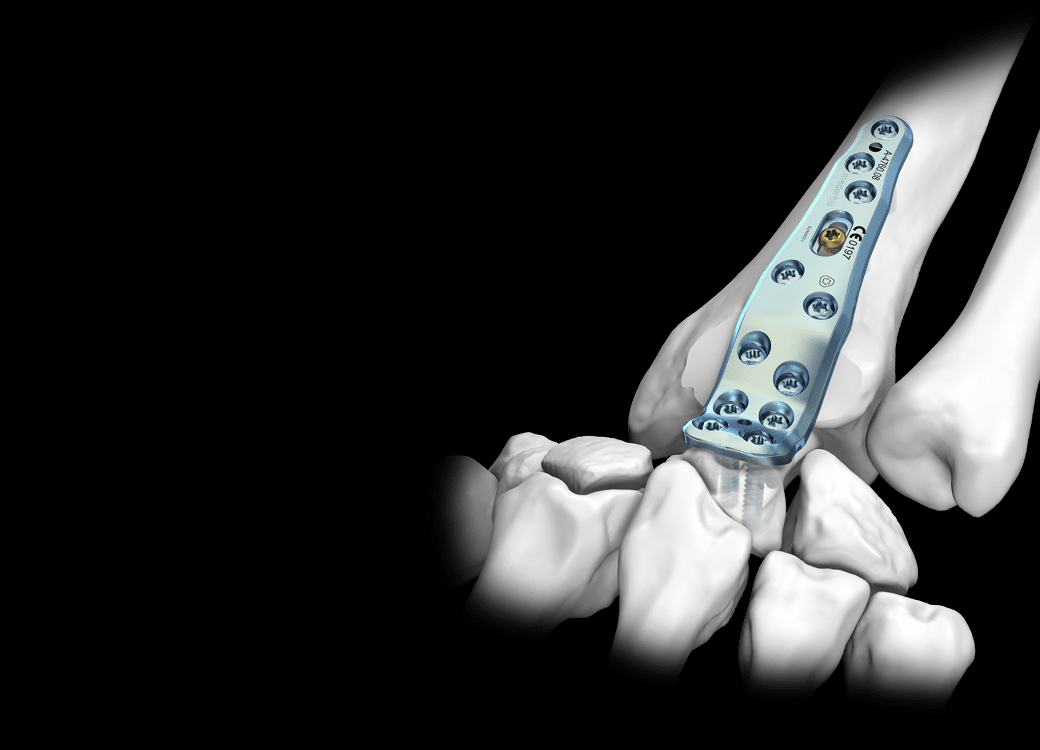 APTUS Arthrodesis System