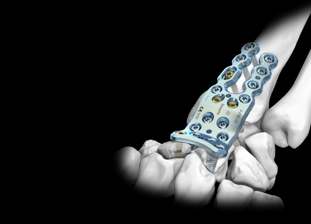 APTUS Arthrodesis System